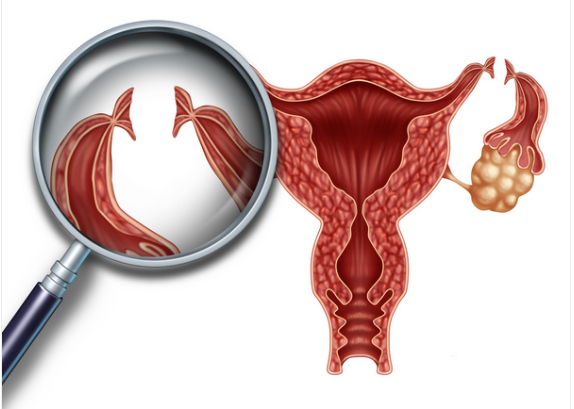 What Is Tubal Ligation Reversal Surgery? 