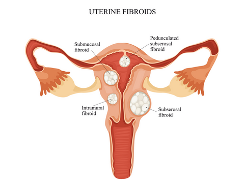 Should I remove fibroids to attain pregnancy?