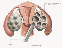 ovarian stimulation